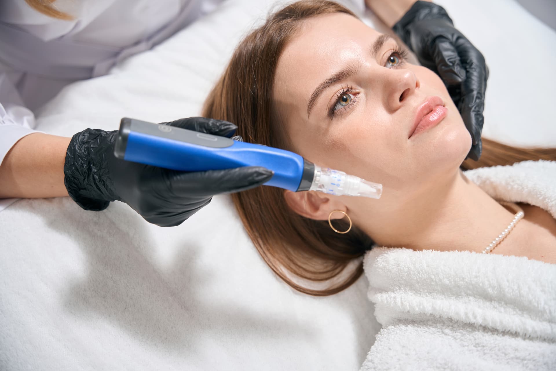 Microneedling-Behandlung mit einem Pen
